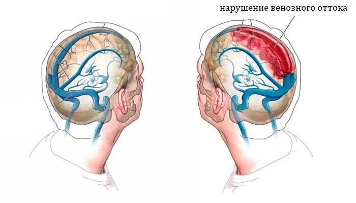 Отток крови от головного мозга. Нарушение венозного оттока. Упражнения для венозного оттока в голове. Нарушен венозный отток.