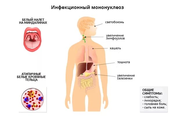 Мононуклеоз у взрослых что это за болезнь. Инфекционный мононуклеоз клинические симптомы. Инфекционный мононуклеоз клинические рекомендации. Инфекционный мононуклеоз (вирус Эпштейна-Барр). Мононуклеоз проявления болезни.