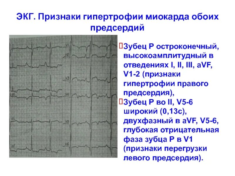 ЭКГ R v6 > 25мм. Зубец в отведениях v1 v2 v5. Гипертрофия правого предсердия v1 v2. Отрицательный зубец р на ЭКГ В v1. Отведение v1 на экг