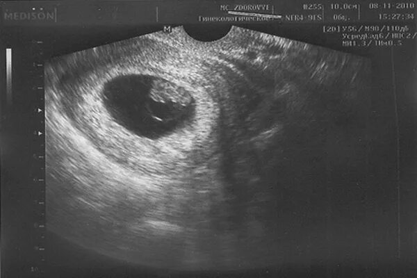 Передача 7 недель. Плод на 7 неделе беременности УЗИ. УЗИ 7 недель беременности. Трансвагинальное УЗИ В 7 акушерских недель. Беременность 7 недель фото эмбриона на УЗИ.