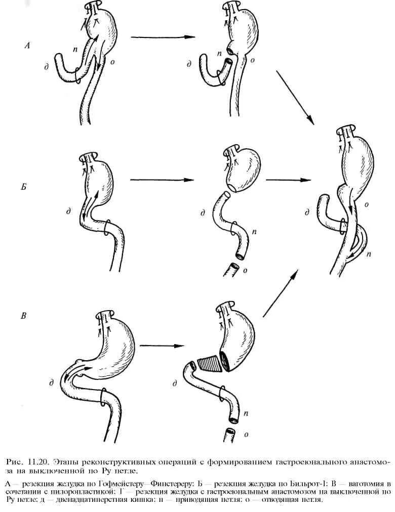 Пдр операция. Операция Бильрот 1 схема операции. Бильрот-2 с гастроеюнальным анастомозом на выключенной по ру петле. Резекция желудка с анастомозом по ру. Резекция желудка Бильрот 2 на петле по ру.