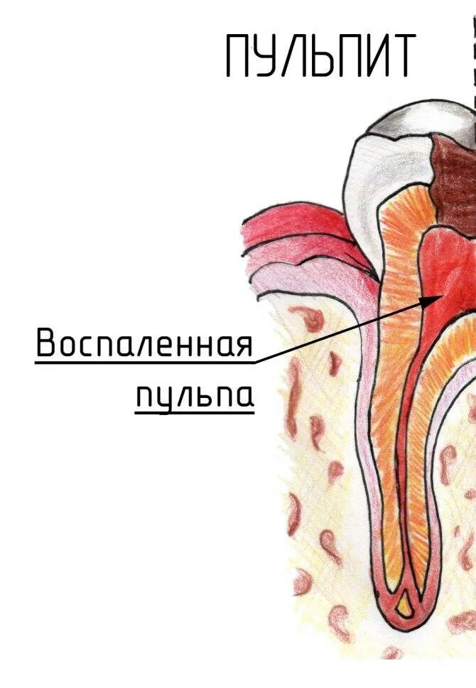 Болит зуб.