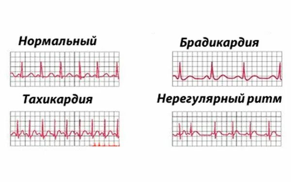 Пульс на ранних сроках. Мерцательная тахикардия на ЭКГ. Аритмия. Тахикардия и брадикардия на ЭКГ. Нарушение ритма.