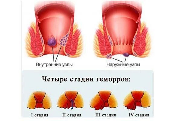 Врач при геморрое у мужчин. Наружный геморроидальный узел 1 степени. Стадии наружного геморроя схема. Начальная стадия геморроя. Геморроидальные шишки.