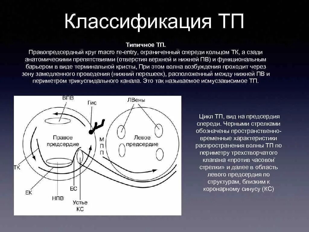 Истмус Зависимое ТП. РЧА трепетания предсердий. Типичная истмус Зависимое трепетание предсердий. Кавотрикуспидального перешейка. Сердце против часовой стрелки