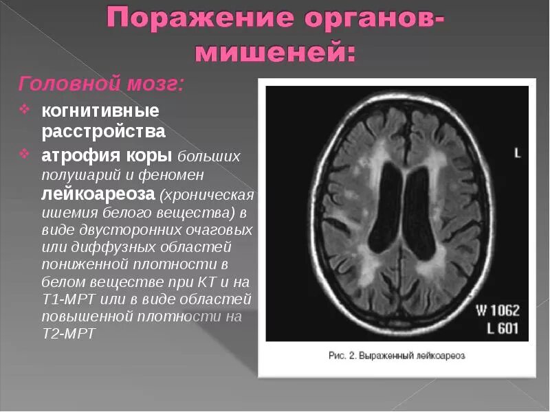 Поражение белого вещества мозга. Рассеянный склероз лейкоареоз. Лейкоареоз головного на кт. Перивентрикулярный лейкоареоз на кт. Лейкоареоз головного мозга на кт.