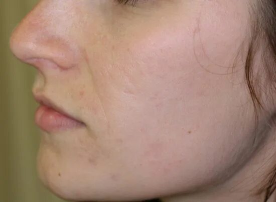 Acne Types There are three main types of acne that you mig. Flickr