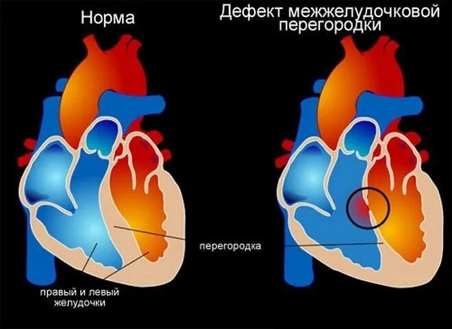 Мышечная перегородка сердца. Дефект межжелудочковой перегородки сердца. врожденные пороки сердца дефект межжелудочковой перегородки. подаортальный дефект межжелудочковой перегородки. дефект межжелудочковой перегородки у новорожденного.