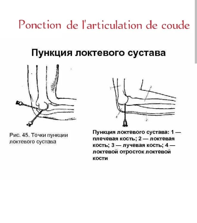 Блокада голеностопного сустава. Точки пункции локтевого сустава. Методика пункции локтевого сустава. Пункция локтевого сустава топографическая анатомия. Пункция локтевого сустава точки пункции.