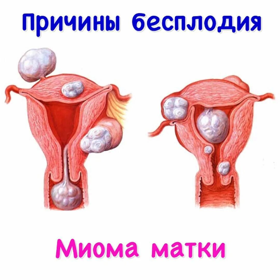 миома матки и эндометриоз. интрамуральная миома матки что это такое. интрамуральный миоматозный узел. фиброма миома матки. фиброма миома матки.