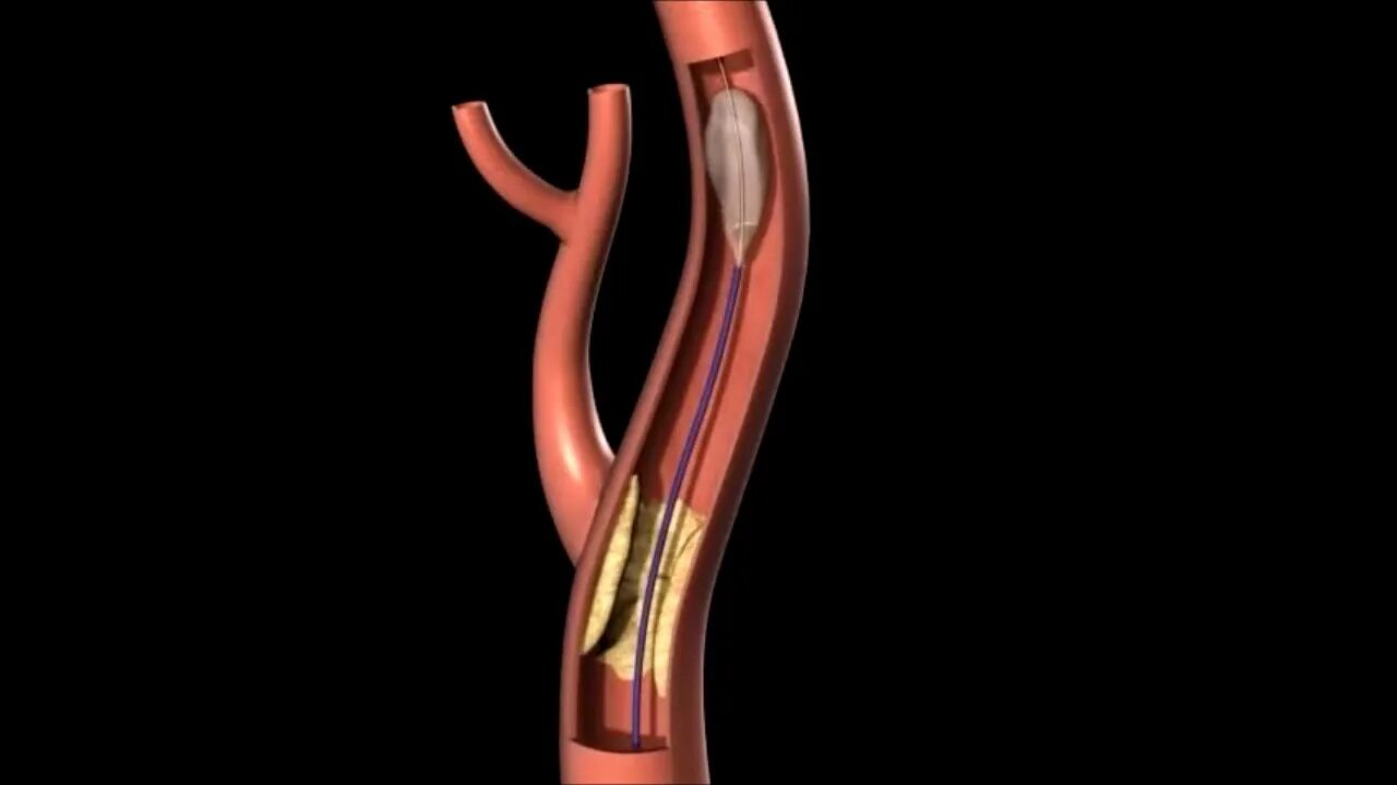 Стент видео. Стентирование сосудов сонной артерии. Каротидное стентирование. Ангиопластика сонной артерии.