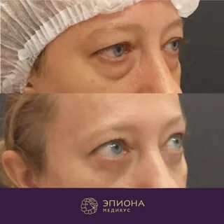 Трансконъюнктивальная блефаропластика