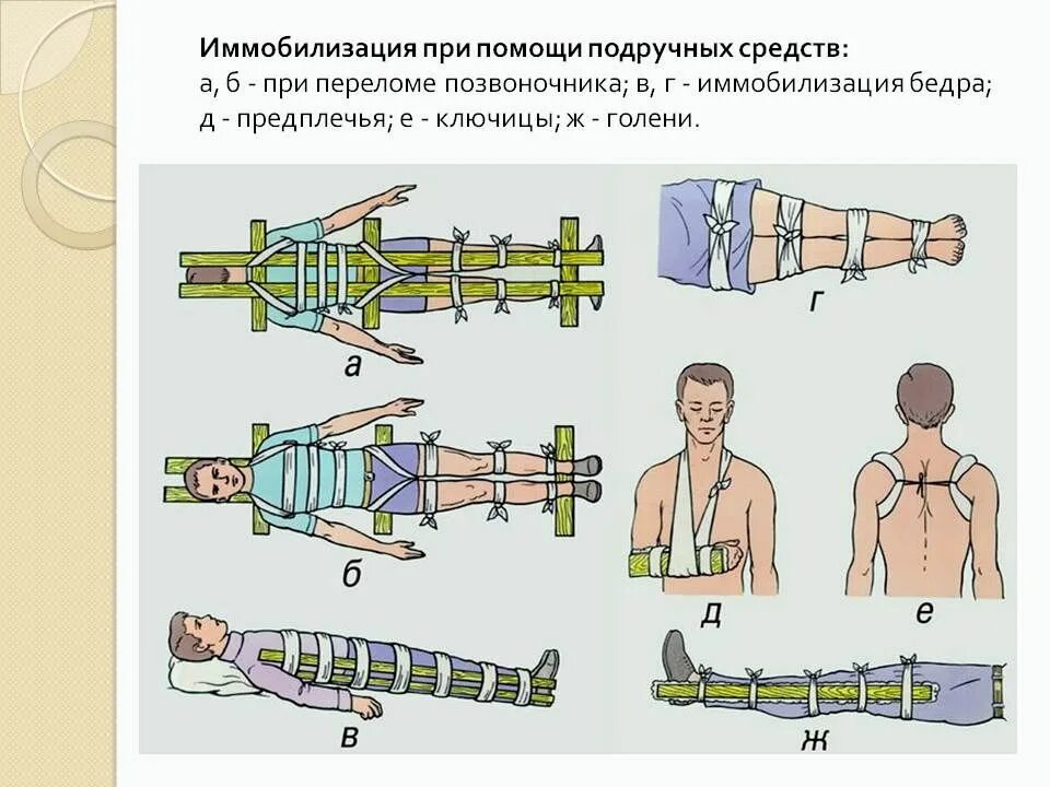 Иммобилизация конечности при переломе. Транспортная иммобилизация пострадавших. Иммобилизация поврежденной конечности при переломах. Иммобилизация при переломе позвоночника.