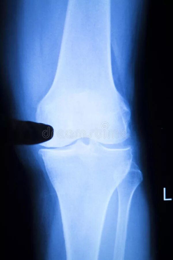 Показать разрыв. Мениск коленного сустава рентген. Повреждение мениска коленного сустава рентген. Разрыв мениска коленного сустава рентген. Разрыв мениска снимок рентген.