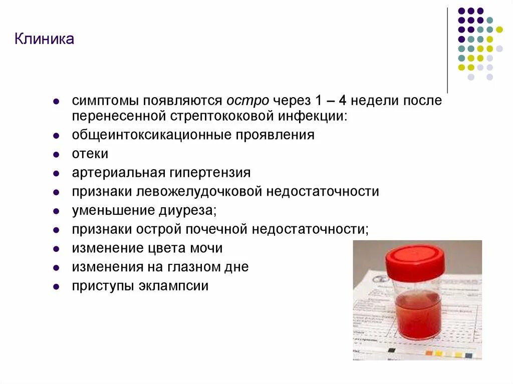 Острый гломерулонефрит цвет мочи. Моча при остром гломерулонефрите цвет. Гломерулонефрит моча цвета мясных помоев. Моча цвета мясных помоев при гломерулонефрите. Изменения в моче при гломерулонефрите