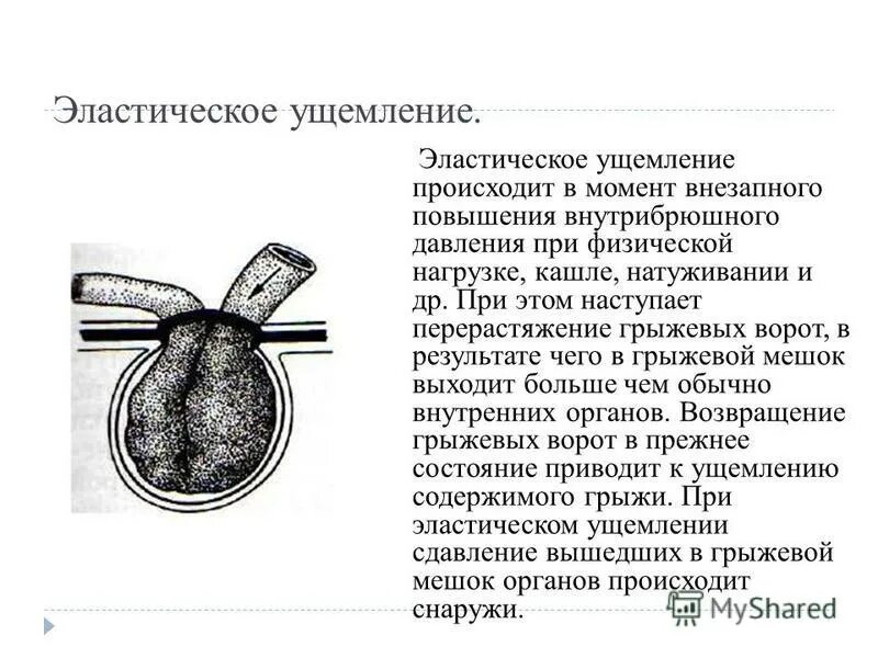 Ответы ущемленная грыжа. Ущемленная грыжа эластическая. Каловое ущемление грыжи. Эластичное ущемление грыжи. Ретроградное ущемление грыжи.