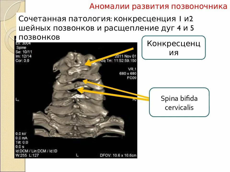 Аномалии развития позвоночника. Аномалии развития позвонков. Конкресценция шейных позвонков кт. Конкресценция поясничных позвонков на кт. Конкресценция шейных позвонков рентген.