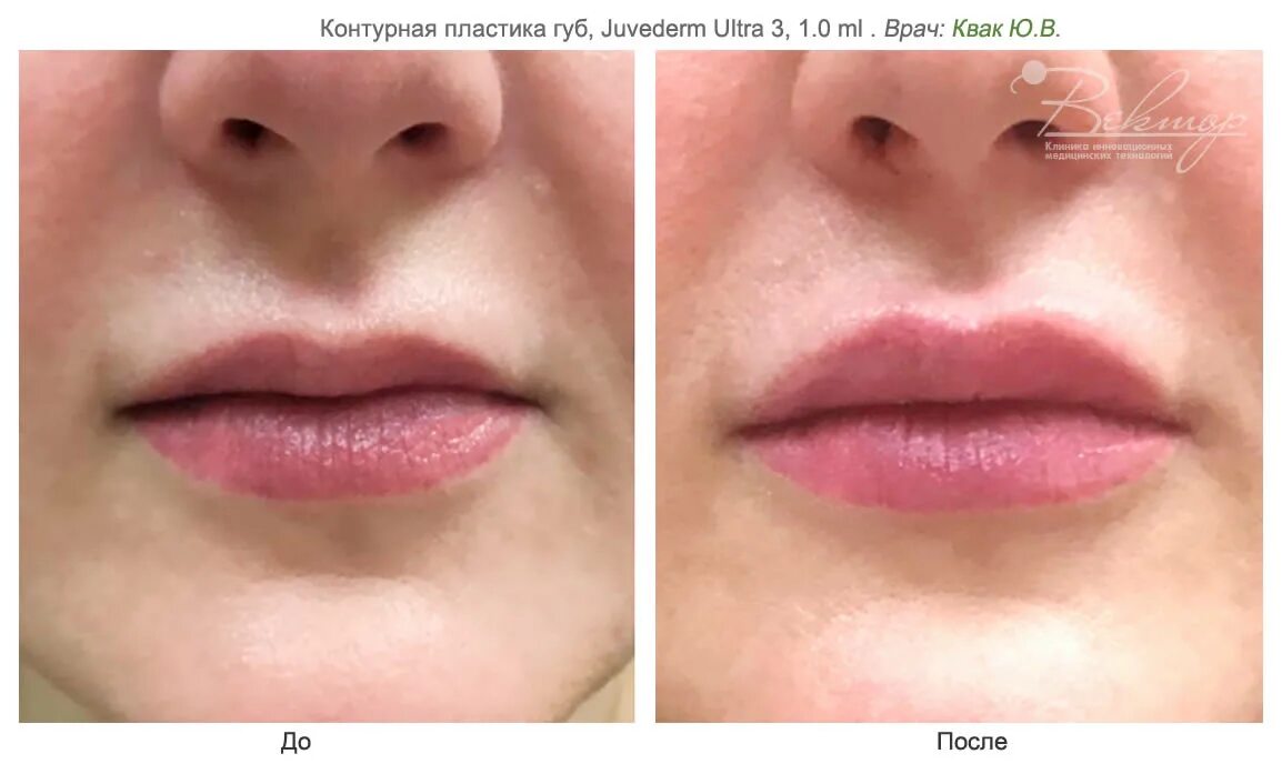 Филлер в губы форум. Контурная пластика Juvederm Ultra 3. Контурная пластика губ гиалуроновой кислотой 1 мл.