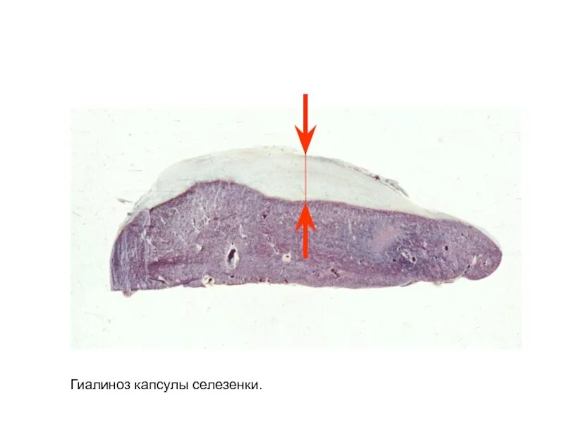 Саговая селезенка. Глазурная селезенка макропрепарат. Гиалиноз капсулы селезенки Глазурная селезенка. Гиалиноз капсулы селезенки макропрепарат. Гиалиноз капсулы селезенки.