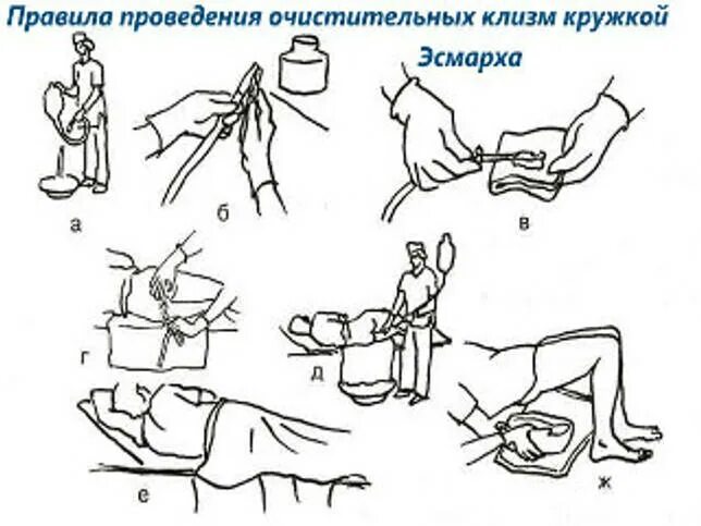 Очистительная клизма. Очистительная клизма алгоритм. Постановка кружки Эсмарха. Очистительная клизма алгоритм выполнения. Очистительная клизма 3