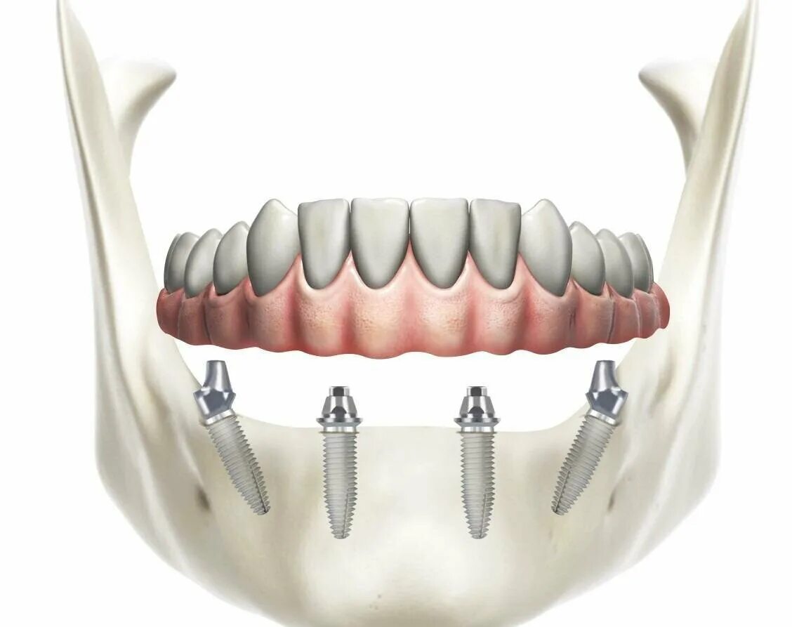 Имплантация всей челюсти all on 4. All on 4 имплантация Нобель. Импланты Nobel all-on 04 зубов.
