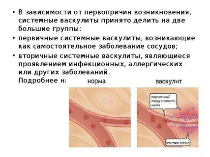 Васкулит лечится