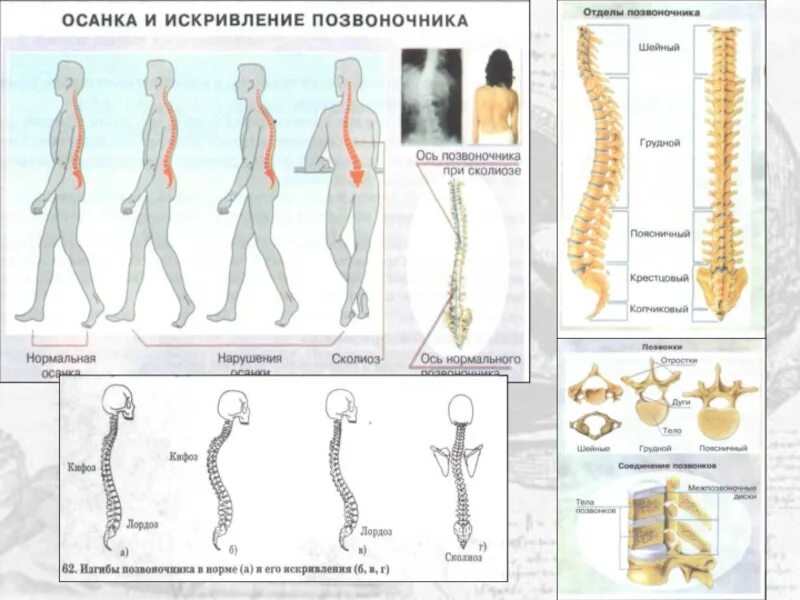 Кифоз грудного отдела степени. Кифоз грудного отдела степени