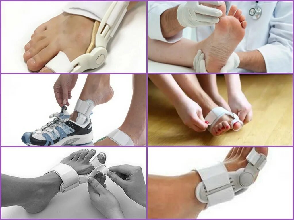 Как убрать косточку на ноге. Корректор халюс вальгус. Вальгусная стопа операция. Операция вальгуса большого пальца. Как убрать косточку на ноге без операции.