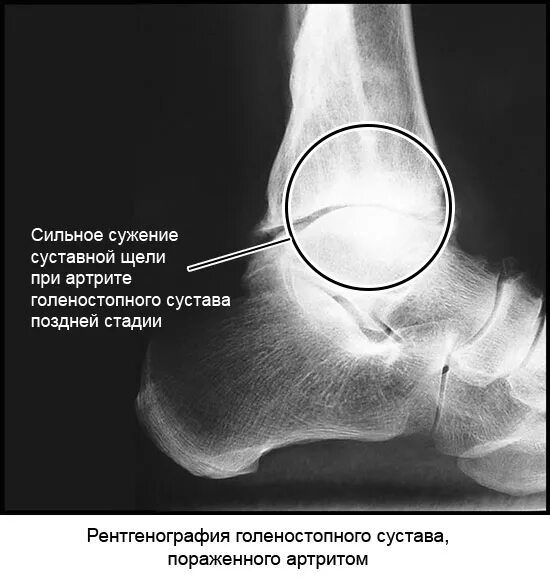 Деформирующий артроз голеностопного сустава рентген. Суставная щель голеностопного сустава норма мм. Остеоартроз голеностопного сустава рентген. Суставная щель голеностопного сустава рентген.