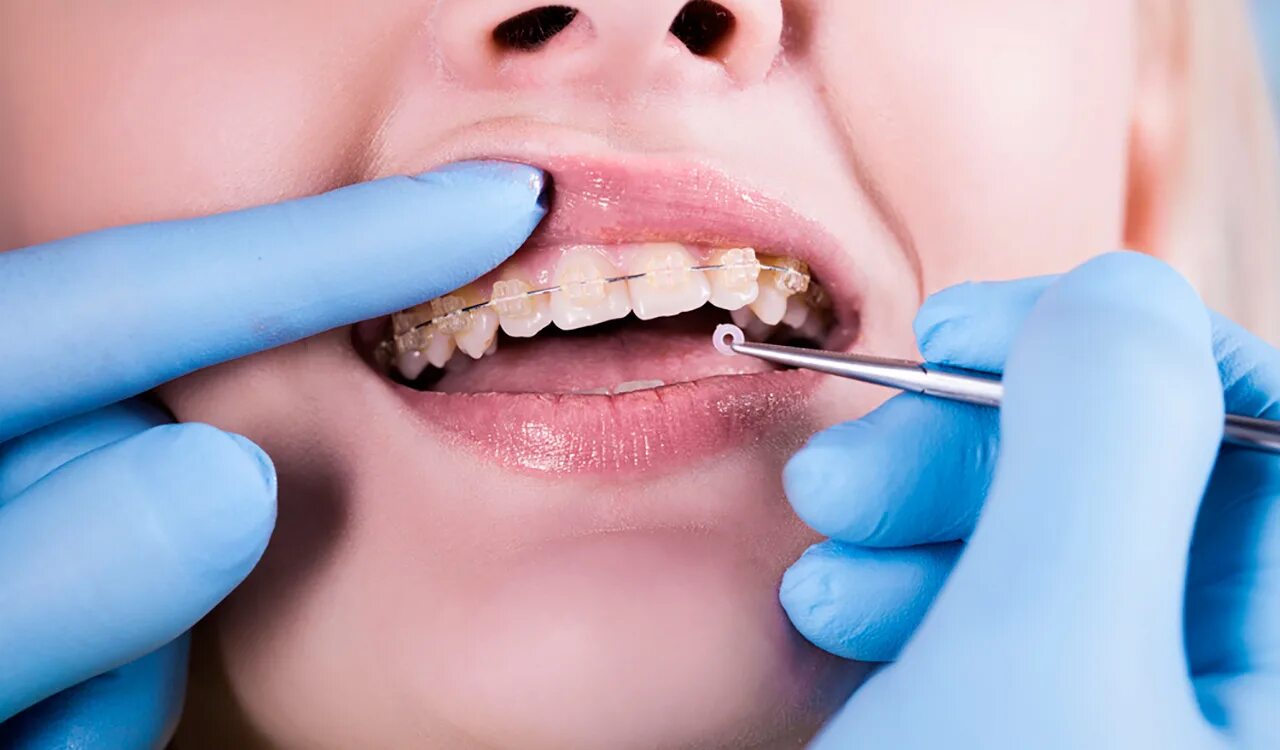Стоматология брекеты. Ортодонтия в стоматологии. Зуба стоматология брекеты. Стоматология ортодонт.