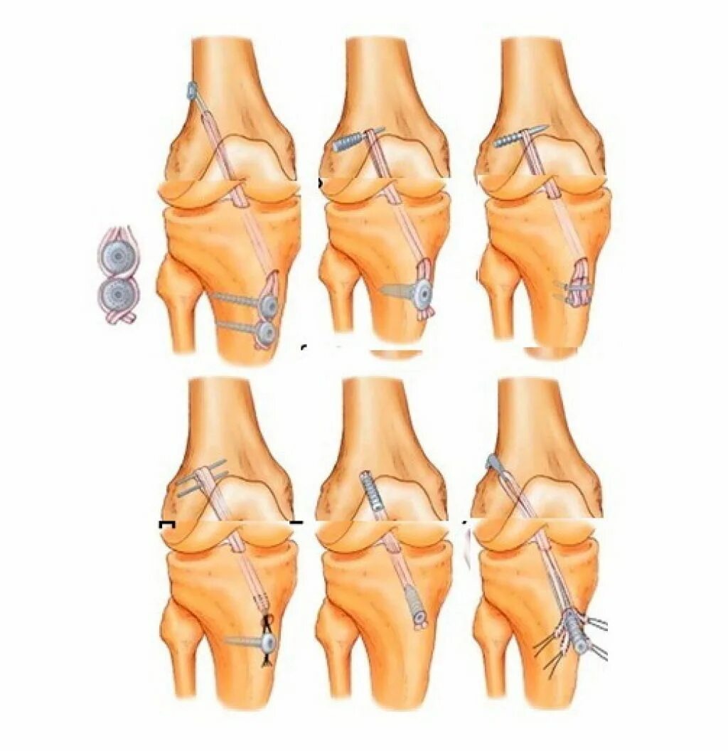 Восстановление сустава без операции. Пластика передней крестообразной связки коленного сустава. Разрыв ПКС коленного сустава операция. ПКС связок коленного сустава. Артропластика ПКС коленного сустава.