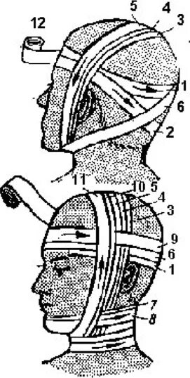 Повязка гиппократа техника наложения. Повязка чепец и шапочка Гиппократа. Перевязка шапка Гиппократа. Шапочка Гиппократа повязка техника наложения. Шапочка Гиппократа повязка алгоритм.