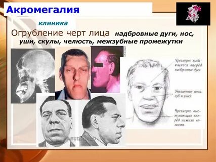 Акромегалия
