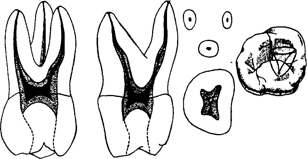 Первый моляр верхней челюсти. Анатомия корневых каналов моляров верхней челюсти. Второй моляр верхней челюсти анатомия каналов. Анатомия 1 моляра верхней челюсти каналы. Корни моляров верхней челюсти.