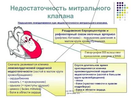 Недостаточность митрального клапана гемодинамика