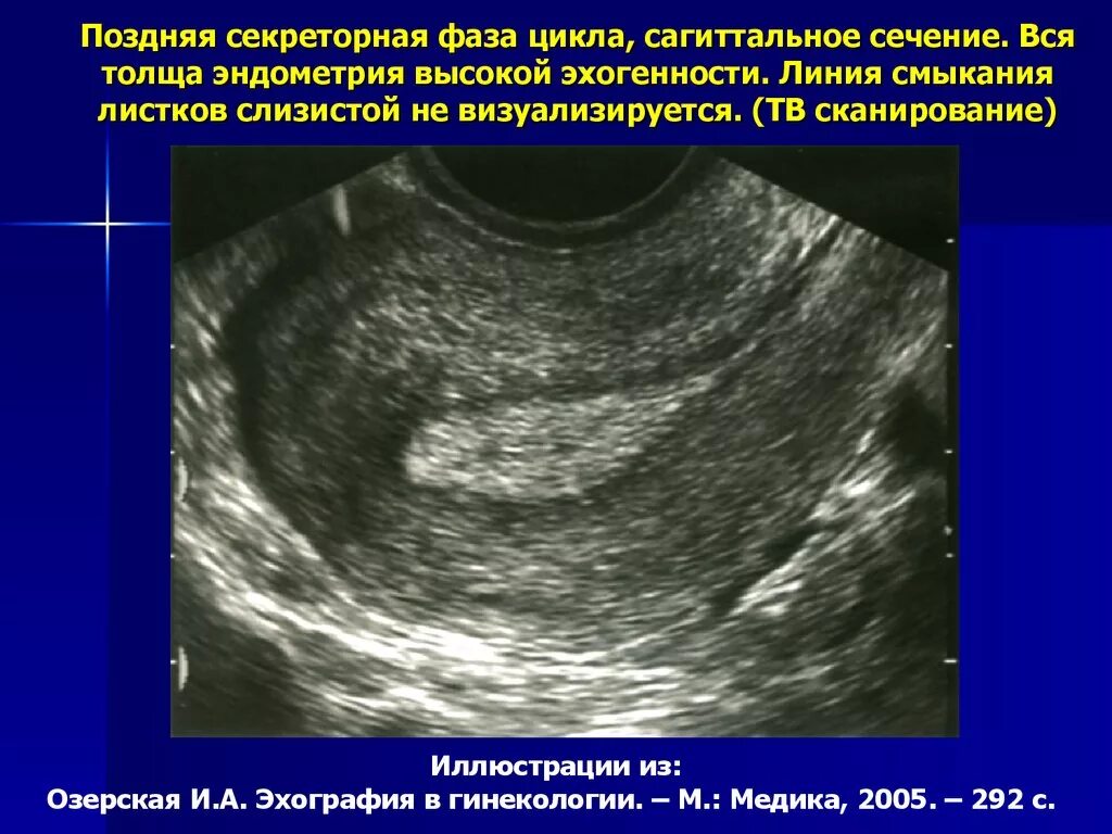 Атипическая гиперплазия эндометрия УЗИ. Ранняя фаза секреции эндометрий УЗИ. УЗИ нормального эндометрия. Эндометрий по УЗИ по фазам цикла. Эндометрия что это такое доступным языком