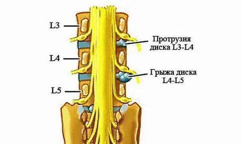 Протрузия диска l4 l5 что это такое