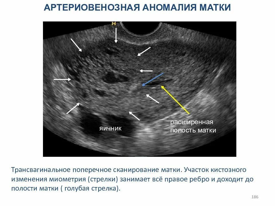 Полость расширена