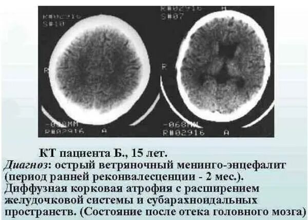 Энцефалит мозга у взрослых. Цитомегаловирус энцефалиты на мрт. Энцефалит при ветряной оспе. Ветряночный энцефалит осложнения. Диагноз ветряная оспа энцефалит.