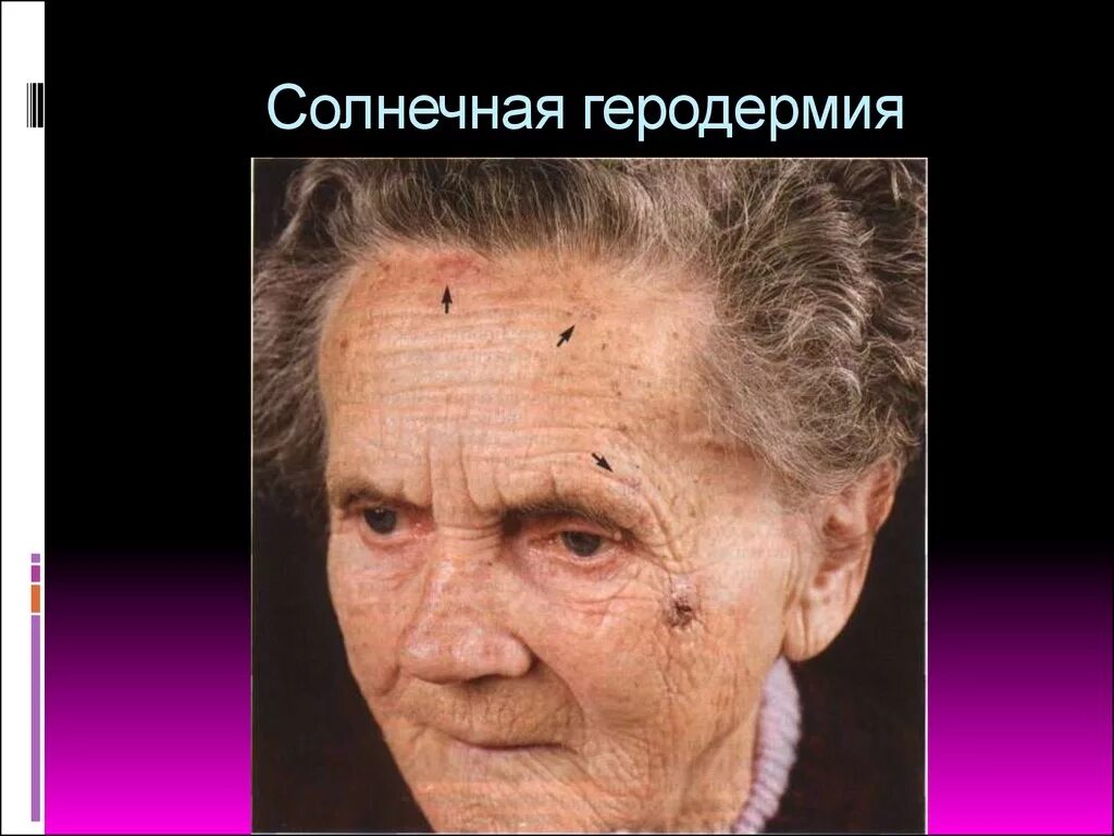 Солнечный эластоз. Эластоз кожи фотостарение.