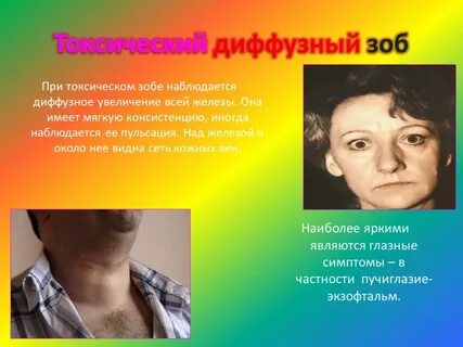 При диффузном токсическом зобе наблюдается