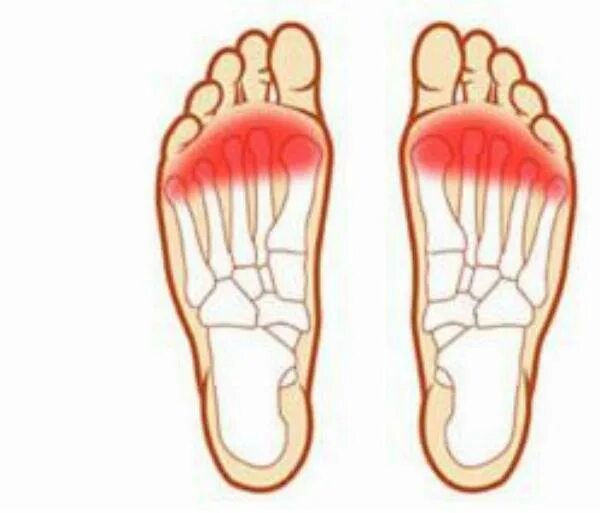 Передняя стопа. Плоскостопие под пальцами. Боли в подошве в середине