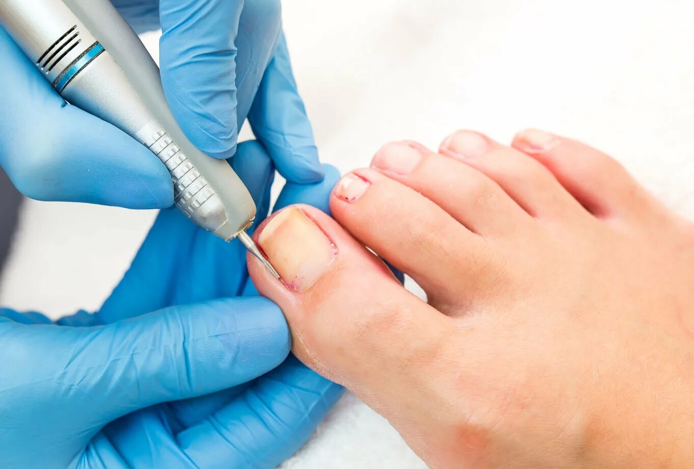 Подолог удаляет ноготь. Подолог удаляет ноготь. Подология грибок ногтей. Хирургический педикюр. Подолог удаляет ноготь.