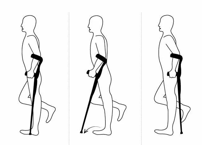Как подниматься по лестнице после эндопротезирования. Костыль с опорой под локоть схема. Ходьба на костылях. Костыли с опорой на локоть. Костыли с опорой на предплечье.