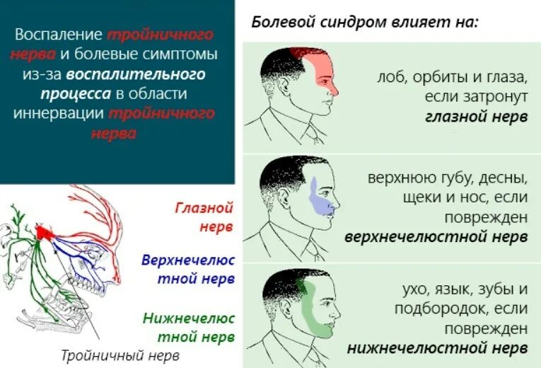 Продуло какие симптомы. Невралгия тройничного нерва причины. признаки невралгии тройничного нерва. терапия невралгии тройничного нерва. воспаление тройничного лицевого нерва симптомы.