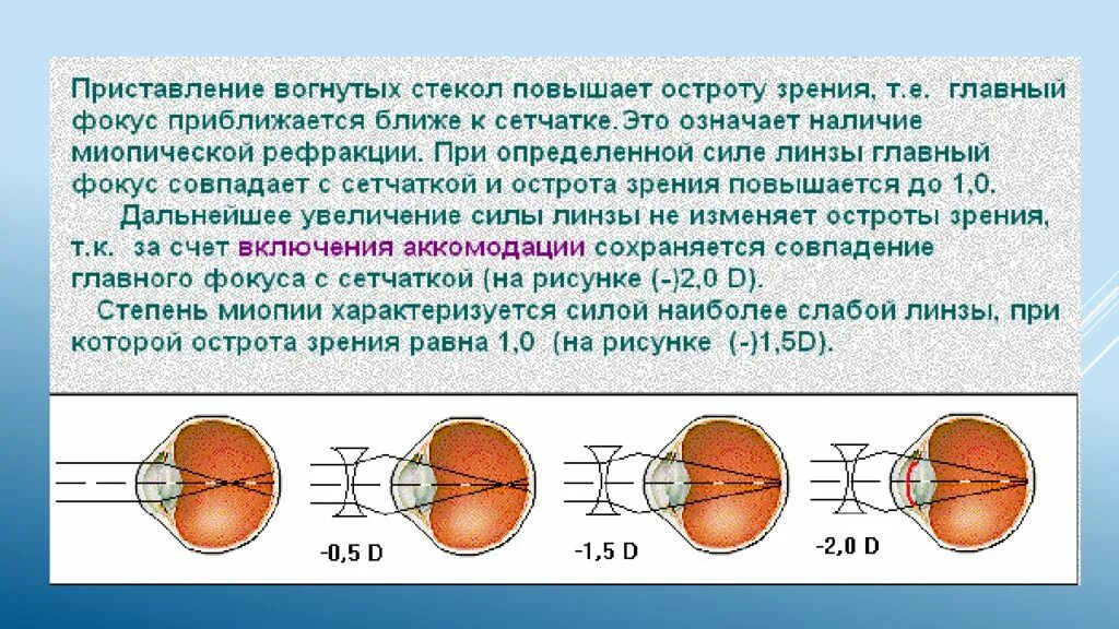 Гиперметропия средней степени глаза. Исследование рефракции зрения метод. Астигматизм рефракция аккомодация. Сложный миопический астигматизм типы. Гиперметропия 1 степени миопический астигматизм.