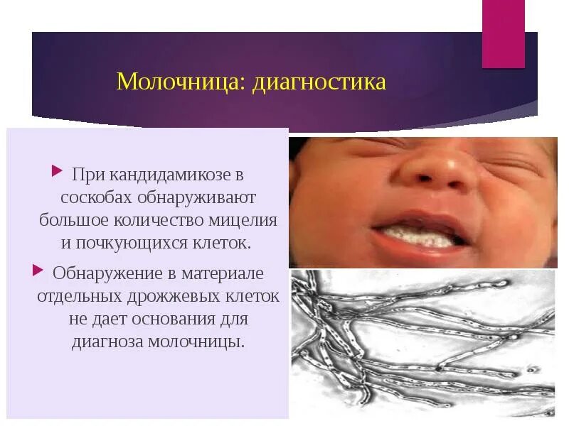 Молочница как выглядит внутри Kandida va uning inson salomatligi uchun xavfi Yomon kayfiyat yomon bo'lishi sha