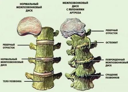 Остеофиты лечение