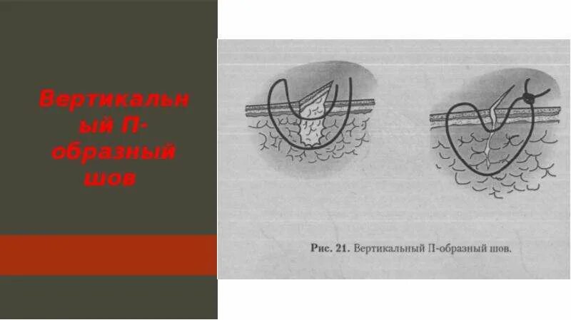 Х образный шов. Зет образный шов в хирургии. П образный шов. Вертикальный п образный шов.