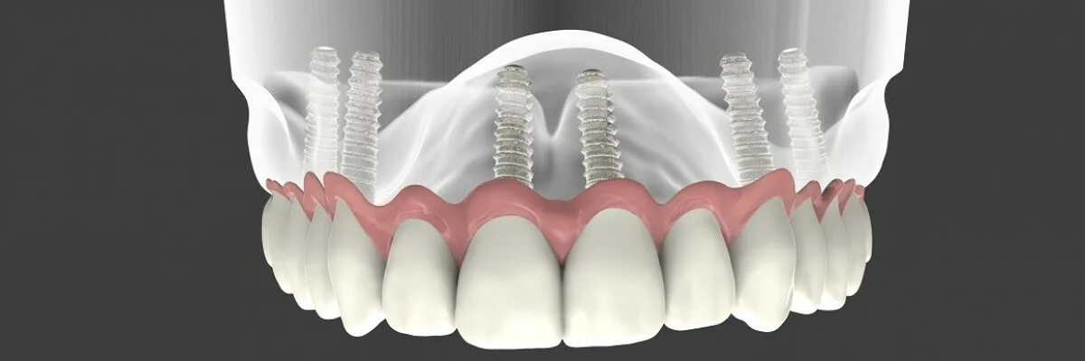 All on 6 цена. Имплант 4 верхняя челюсть. Имплантация челюсти на 4 имплантах. Имплантация верхней челюсти на 6 имплантах этапы. Имплантация челюсти на 6 имплантах.